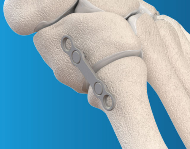 NeoSpan® Compression Implant System - Surgical Technique Guide