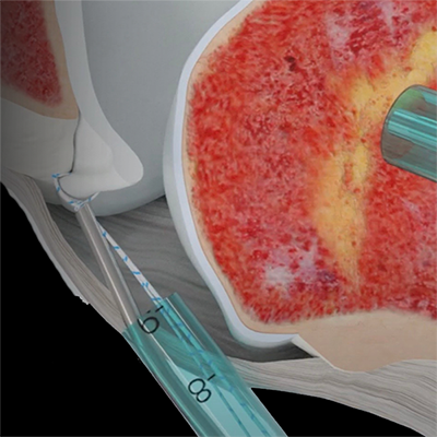 animation of paradigm ezswitch being used in a hip arthroscopy procedure