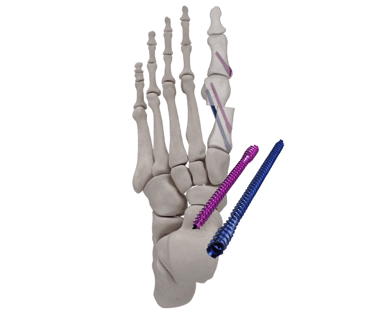 IBS™-B Beveled Screws