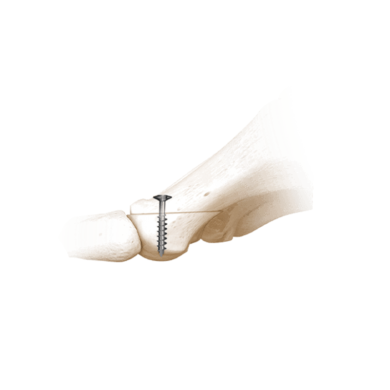 ibs-compression-screws-in-joint