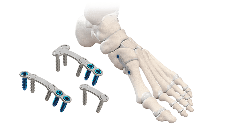 NeoSpan Compression Implant System and representation of the system used on a foot bone