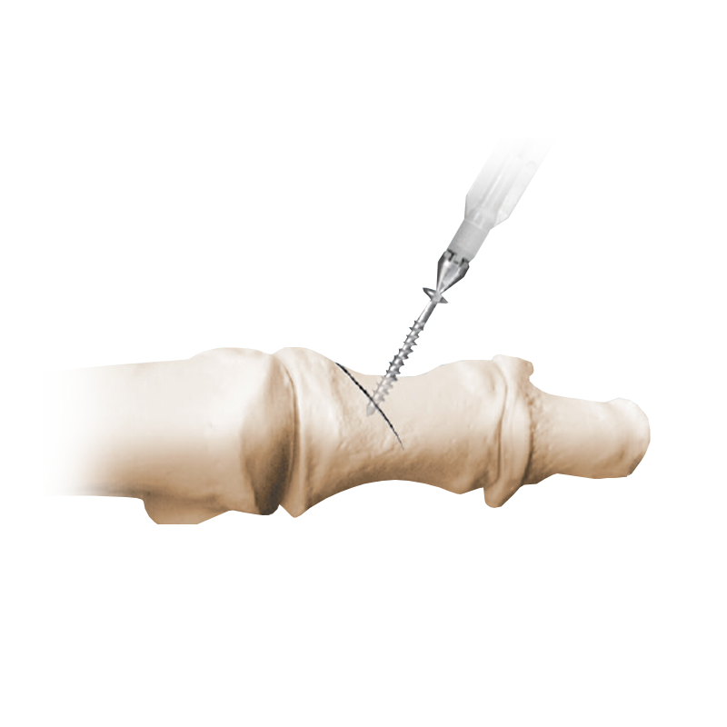 NeoSys<sup>®</sup> Single-Use Instrumentation
