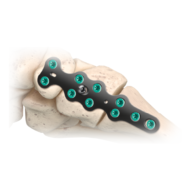 CoLink<sup>®</sup> Mfx Midfoot Plating System