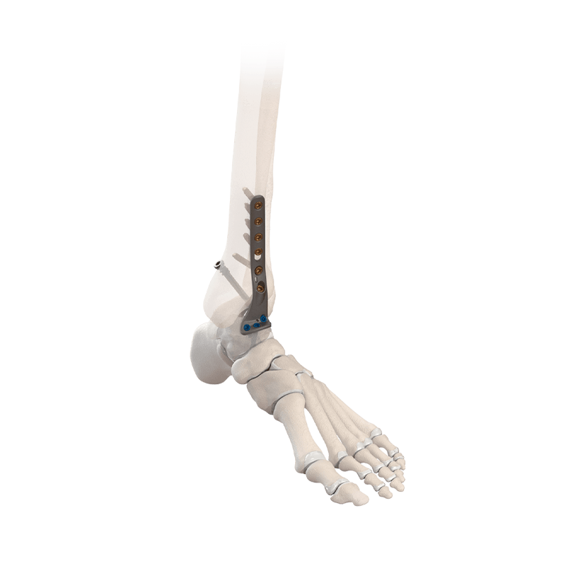 CoLink<sup>®</sup>  NeoFuse Ankle Fusion Plating System
