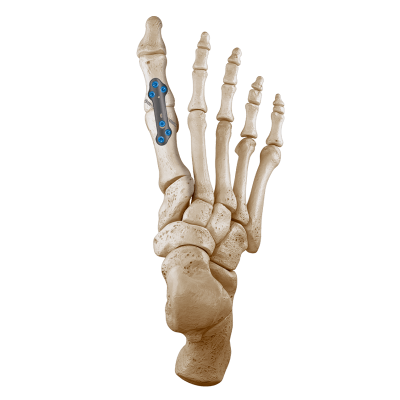 CoLink<sup>®</sup>  NX MTP Compression Plating System