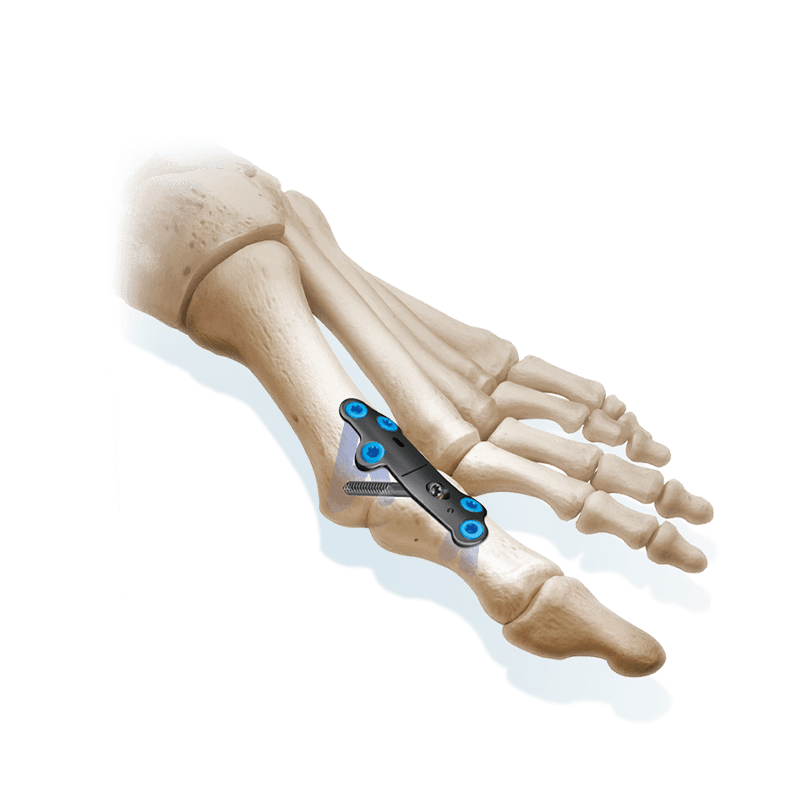 CoLink<sup>®</sup> XP Plating System
