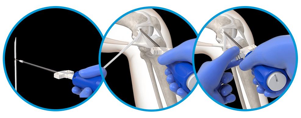 Anchor the BioBrace implant proximally by passing the tapered end through the Argo Knotless GENESYS eyelet, insert to laser line, and thread to final seating