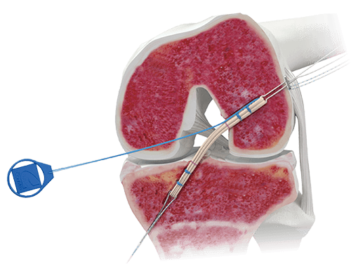 infinity femoral button shown in animated knee