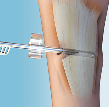 ClearGuard LE Gastrocnemius Recession