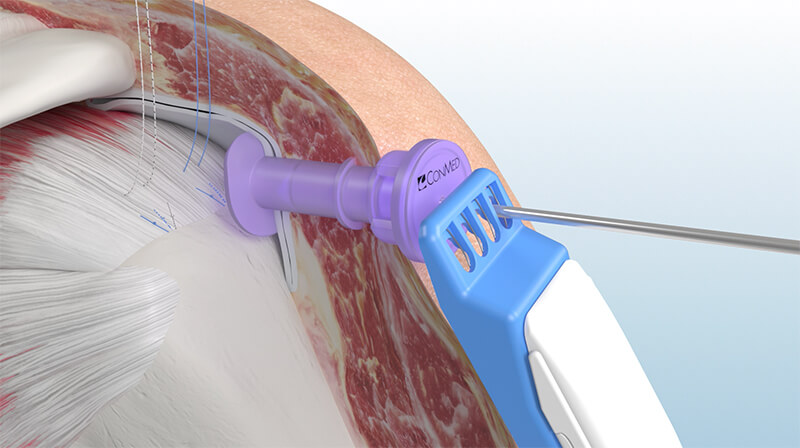 BioBraceRC applied to shoulder
